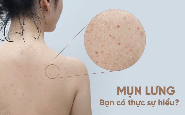 Xà phòng trị mụn lưng là gì? Gợi ý 6 loại xà phòng trị mụn lưng hiệu quả nhất